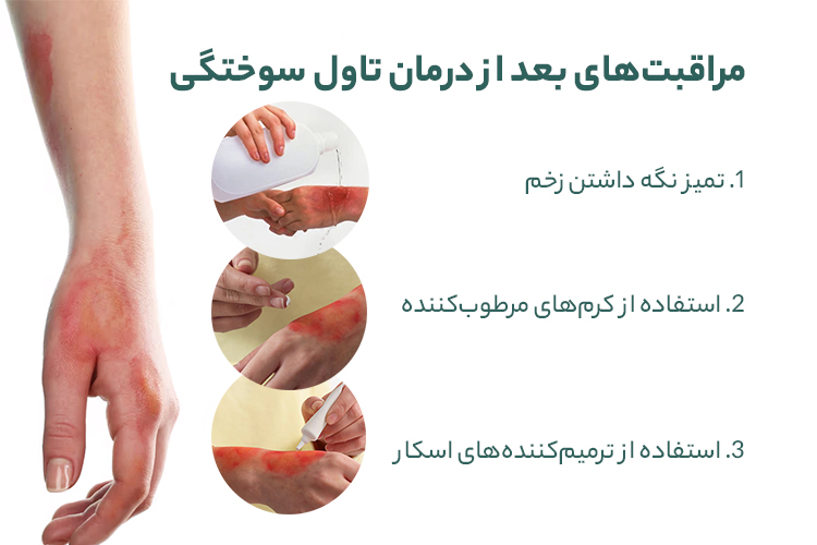 مراقبت های بعد از درمان تاول سوختگی